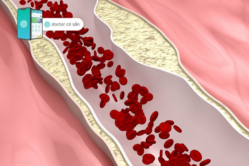 Thuốc Atorvastatin làm giảm tiến triển xơ vữa mạch vành